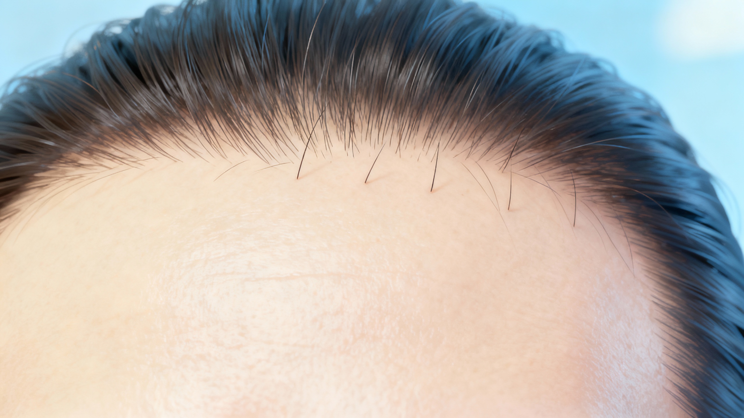 Featured image for Finding Relief: Optimal Approaches to Seborrheic Dermatitis Management