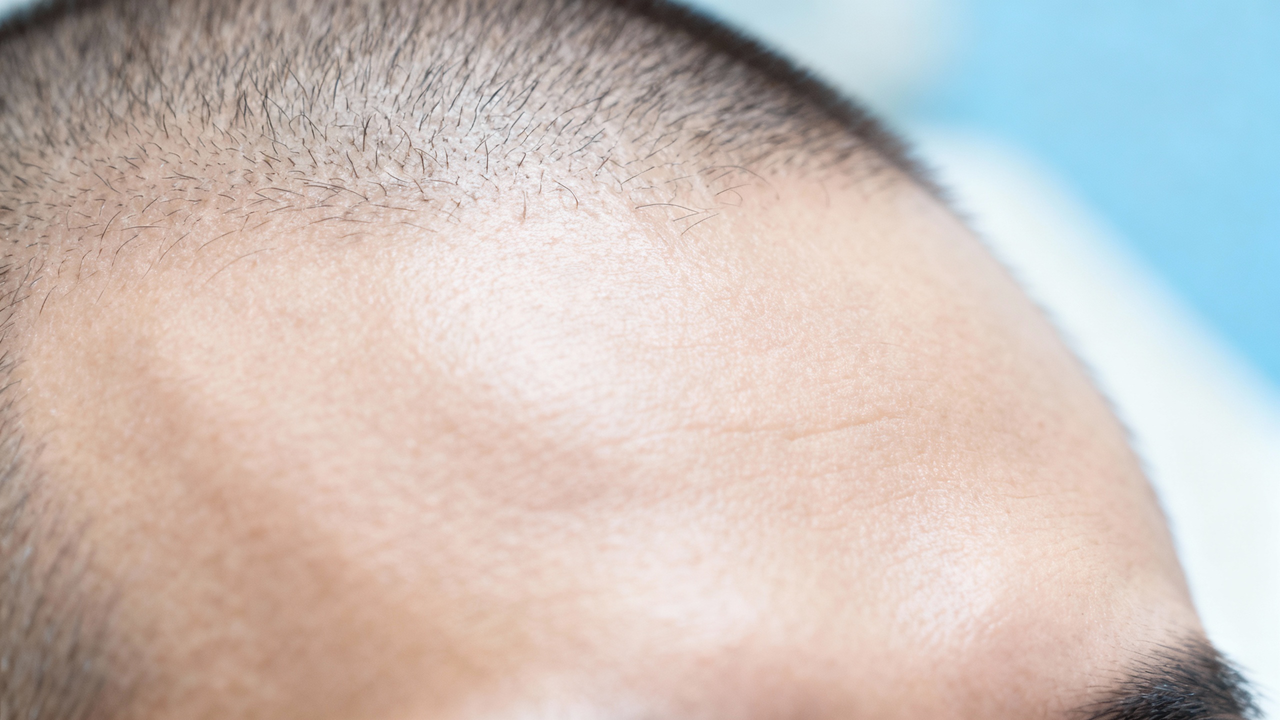 Featured image for Combat the Redness: Advanced Treatment Options for Seborrheic Dermatitis